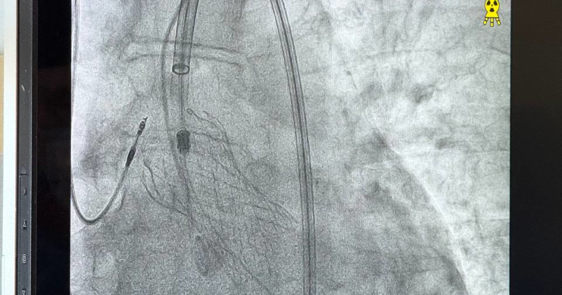 Sensational Breakthrough in the Medical World: A Unique Heart Surgery Performed for the First Time in Poltava