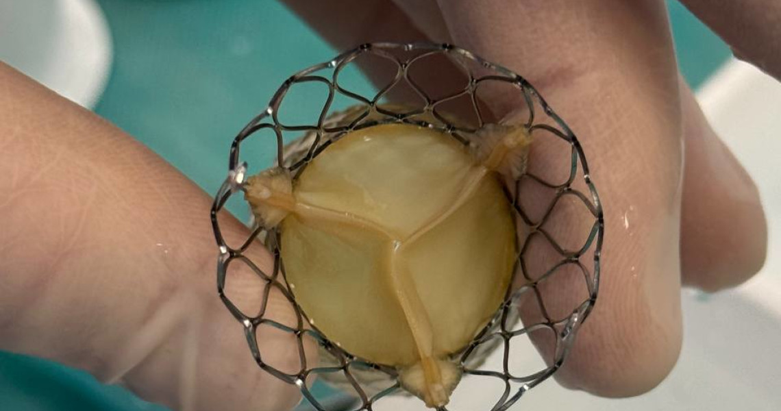 Sensational Breakthrough in the Medical World: A Unique Heart Surgery Performed for the First Time in Poltava
